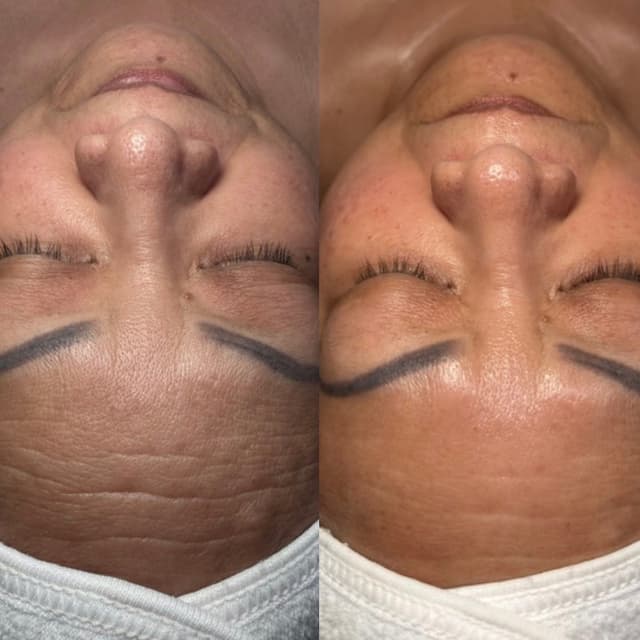 SWiCH Rejuvenation Series at Elevate Aesthetics in Sandy, UT